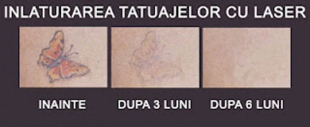 Inlaturarea tatuajelor cu laser in Timisoara - Giroc