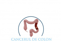 Cancerul de colon