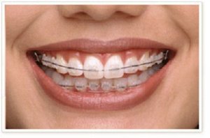 Smile Factory - Invisalign