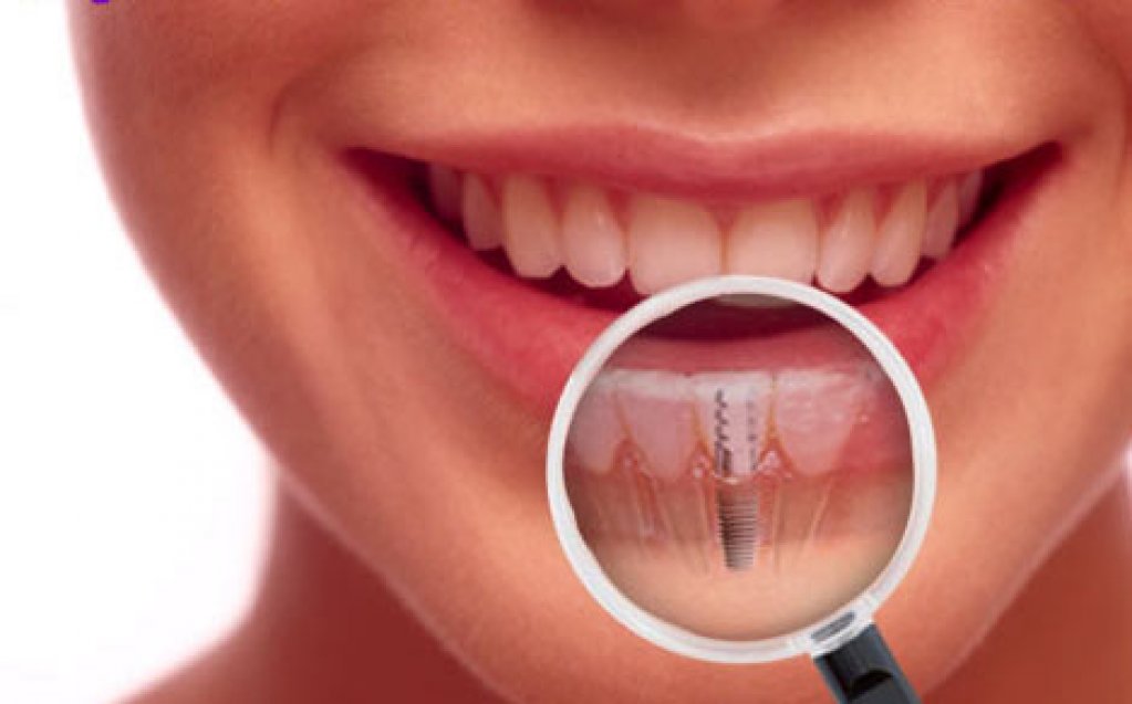 Implanturi dentare ieftine sau scumpe?