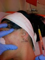 Terapia PRP (Platelet Rich Plasma)