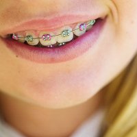 Aparatul dentar pentru adulti – La ce sa te astepti cand il dai jos