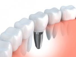 6 motive pentru a opta pentru un implant dentar in vederea completarii spatiilor libere din cavitatea bucala