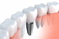 6 motive pentru a opta pentru un implant dentar in vederea completarii spatiilor libere din cavitatea bucala