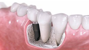 Iata ce presupune aditia osoasa din cadrul tratamentelor cu implant dentar!