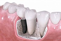 Iata ce presupune aditia osoasa din cadrul tratamentelor cu implant dentar!