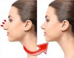 Ce este rinoplastia?
