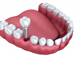 Obține zâmbetul mult dorit cu ajutorul unui implant dentar