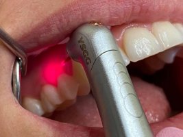 10 motive pentru care să alegi tratamentul cariilor cu laserul stomatologic
