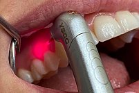 10 motive pentru care să alegi tratamentul cariilor cu laserul stomatologic