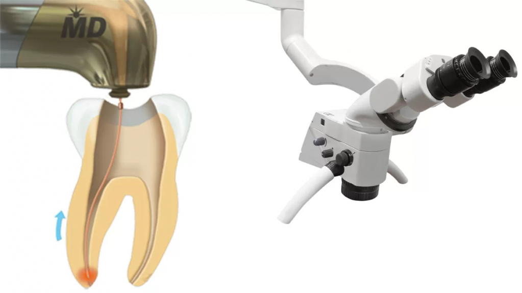 Tratamentul de canal asistat laser în clinica stomatologică Life Dental Spa