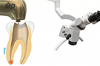 Tratamentul de canal asistat laser în clinica stomatologică Life Dental Spa