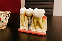 Avantajele și dezavantajele unui implant dentar/Ce trebuie sa știi despre implantul dentar