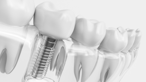 Ce este un implant dentar?