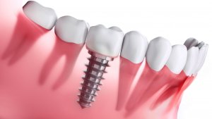 Implantul dentar: ce presupune si cand este recomandat?