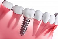 Implantul dentar: ce presupune  si cand este recomandat?