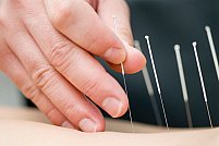 Preturi la acupunctura in Bucuresti