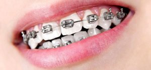 Care sunt avantajele de care te bucuri atunci când porți aparat dentar?