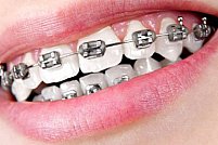 Care sunt avantajele de care te bucuri atunci când porți aparat dentar?