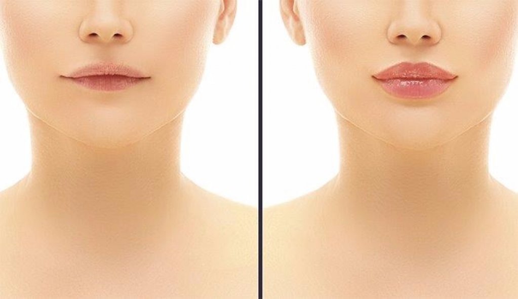 Cum poți obține un rezultat natural după injectarea cu acid hialuronic?