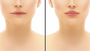 Cum poți obține un rezultat natural după injectarea cu acid hialuronic?