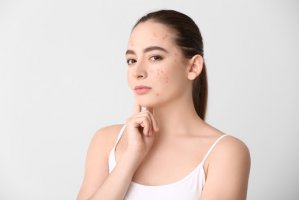 Rutina de îngrijire a tenului cu tendință acneică