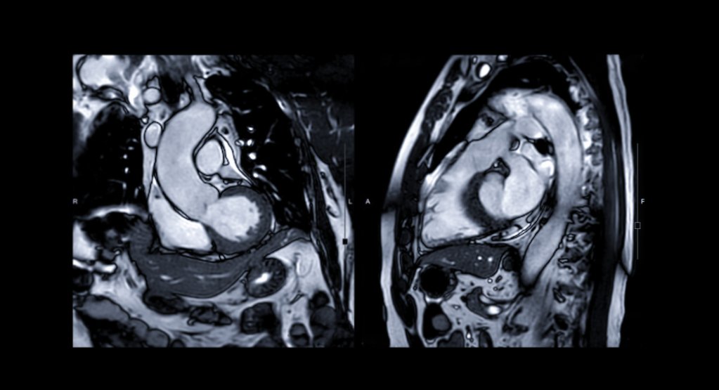 Coronarografia vs. Rezonanta magnetica (RMN): care sunt diferențele?