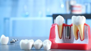 De ce să alegi implanturile dentare în detrimentul protezelor