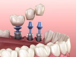 Dr. Dan Gabriel Gruia: inovație și excelență în artă implantologiei dentare