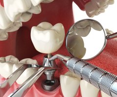 Cat de importanta este sanatatea oaselor pentru operatia cu implant dentar?