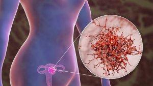 Cancerul de col uterin - o problemă majoră de sănătate publică. Ce șanse de vindecare are?