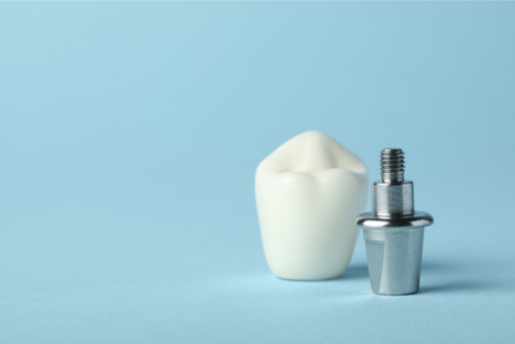 Implantul dentar - eficiența sa în estetica dentară