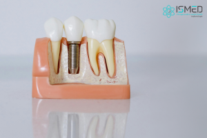 Top 3 beneficii pentru care ar trebui să apelezi la o implantologie dentară! Cum alegi medicul?