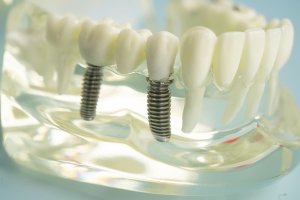 Implant dentar în București: ce trebuie să știi despre procedură și recuperare?