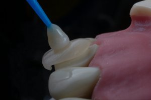 Cu ce se lipesc fatetele dentare?