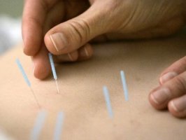 Ce este si ce vindeca acupunctura?