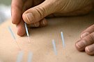 Ce este si ce vindeca acupunctura?