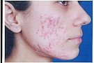 Tratamente pentru acnee si cicatrici