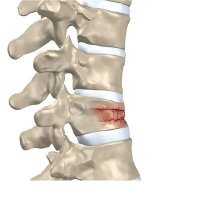 Osteoporoza - riscuri de imbolnavire