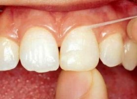 Cum se foloseste ata dentara