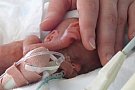 Efectele nasterii premature Efectele nasterii premature