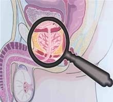 Cancerul de prostata