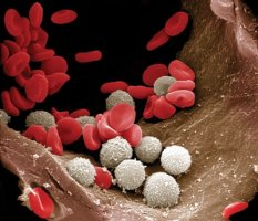 Cauzele si simptomele cresterii hemoglobinei