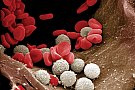 Cauzele si simptomele cresterii hemoglobinei