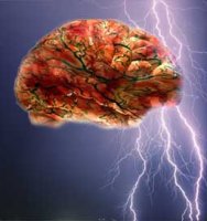 Epilepsia